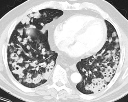 Metastatatic Squamous Cell Lung Cancer Radiology Case Radiopaedia Org