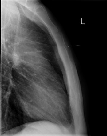 Sternal Fracture Radiology Reference Article Radiopaedia Org