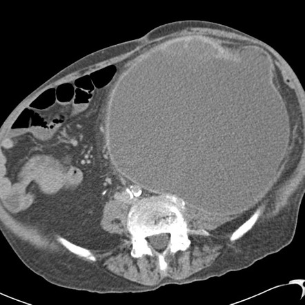 Abdominal Hernia Radiology Reference Article Radiopaedia Org