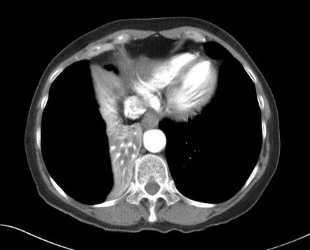 Right Middle And Lower Lobe Collapse Secondary To Endobronchial Non Small Cell Lung Cancer