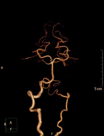 Vertebral Artery Radiology Reference Article Radiopaedia Org