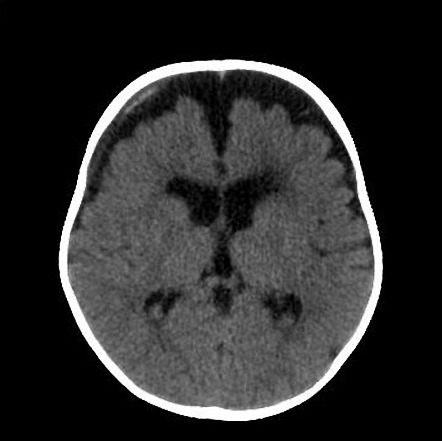 Chronic Subdural Hematoma Radiology Case Radiopaedia Org