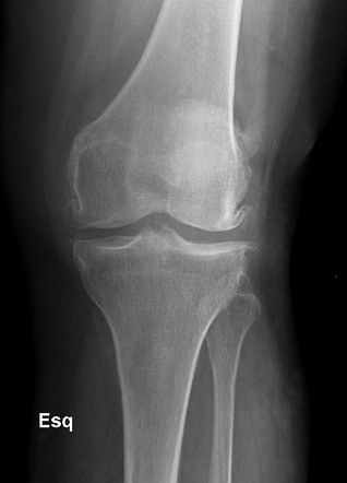 Osteoarthritis Basic Radiology Reference Article Radiopaedia Org