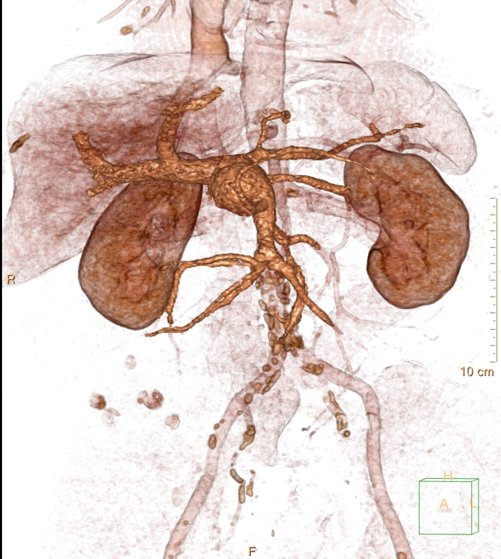 Extra Hepatic Portal Venous Aneurysm Image Radiopaedia Org