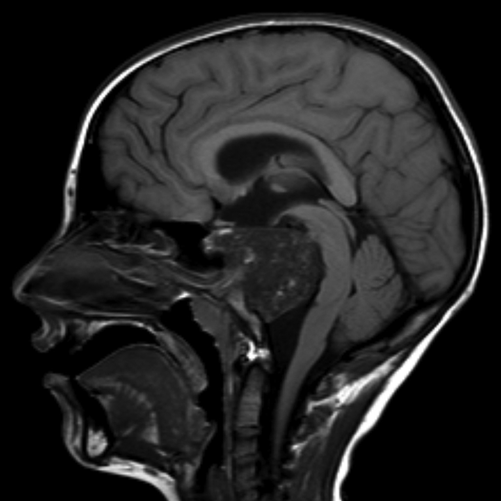 Chordoma Clivus Image Radiopaedia Org