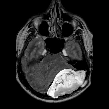 Intracranial Epidermoid Cyst Radiology Reference Article