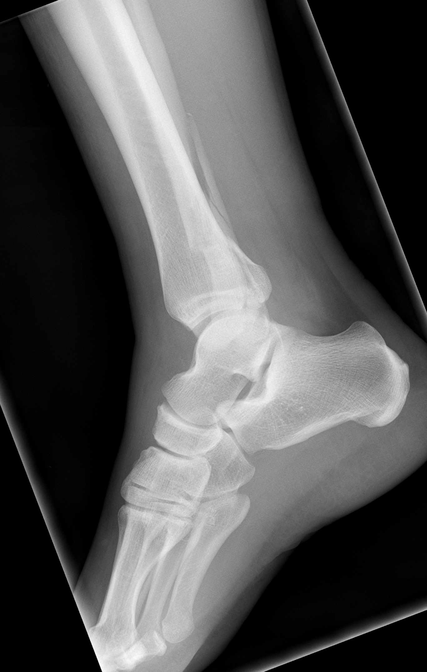 Ankle Trimalleolar Fracture Weber C And Posterior Malleolus Fractures