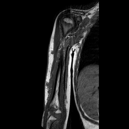 Plexiform Neurofibromas Image Radiopaedia Org