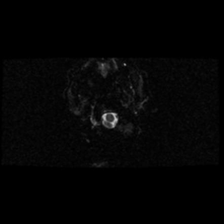 Acoustic Schwannoma Image Radiopaedia Org