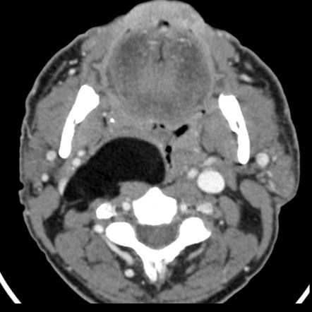 Parapharyngeal Lipoma Radiology Case Radiopaedia Org