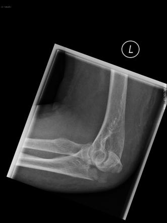 Olecranon Fracture Radiology Reference Article Radiopaedia Org