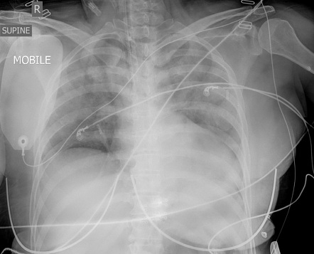 Neurogenic Pulmonary Edema Radiology Reference Article Radiopaedia Org