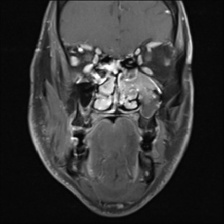 Fibroepithelial Sinonasal Polyp Image Radiopaedia Org