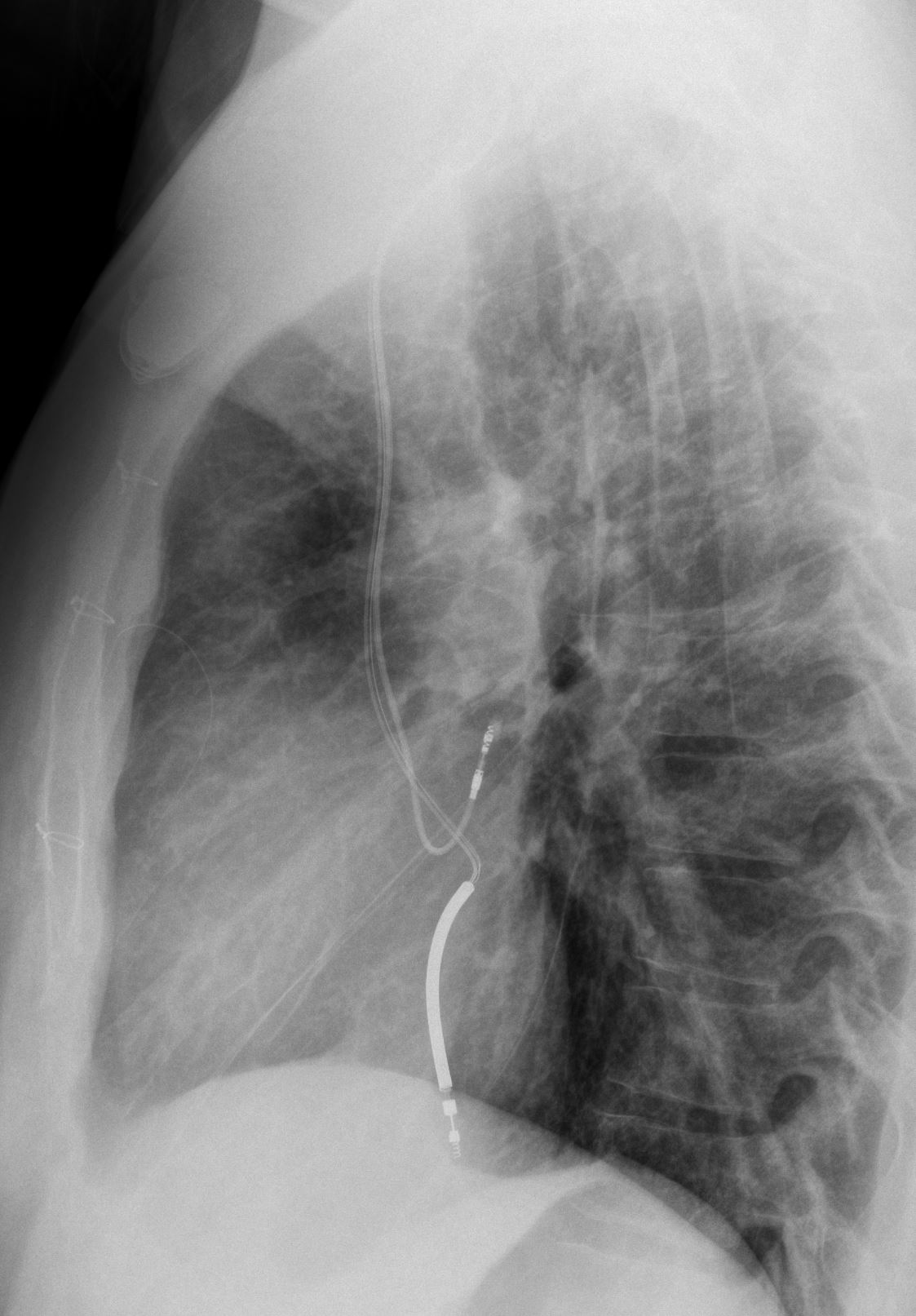 D Tga Atrial Switch Procedure And Pacemaker Image Radiopaedia Org