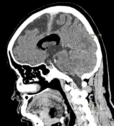 Pericallosal Lipoma Radiology Case Radiopaedia Org