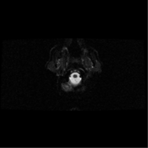 Progressive Multifocal Leukoencephalopathy Image Radiopaedia Org