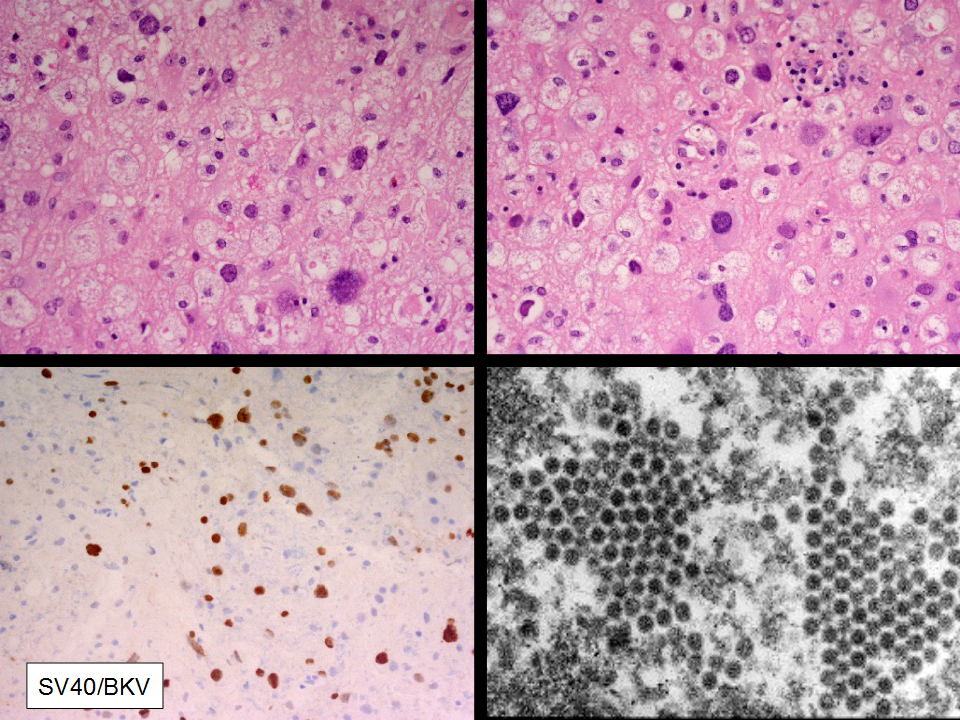 Progressive Multifocal Leukoencephalopathy Image Radiopaedia Org