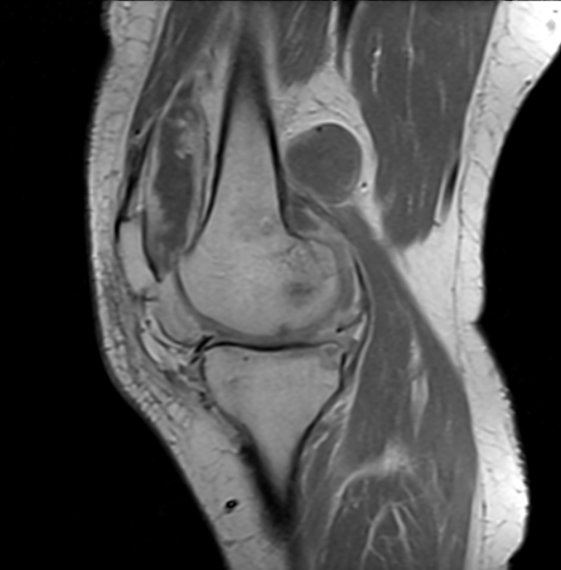 Pigmented Villonodular Synovitis Knee Image Radiopaedia Org