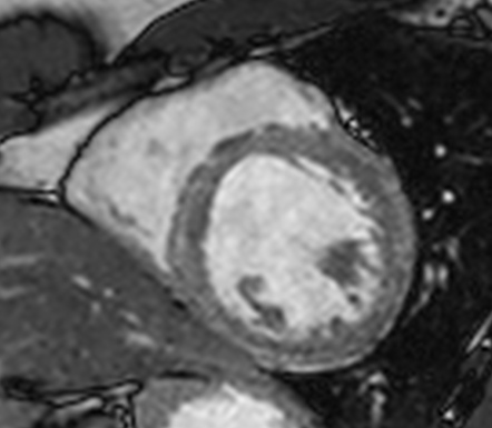 Sarcoidosis Cardiac Manifestations Radiology Reference Article