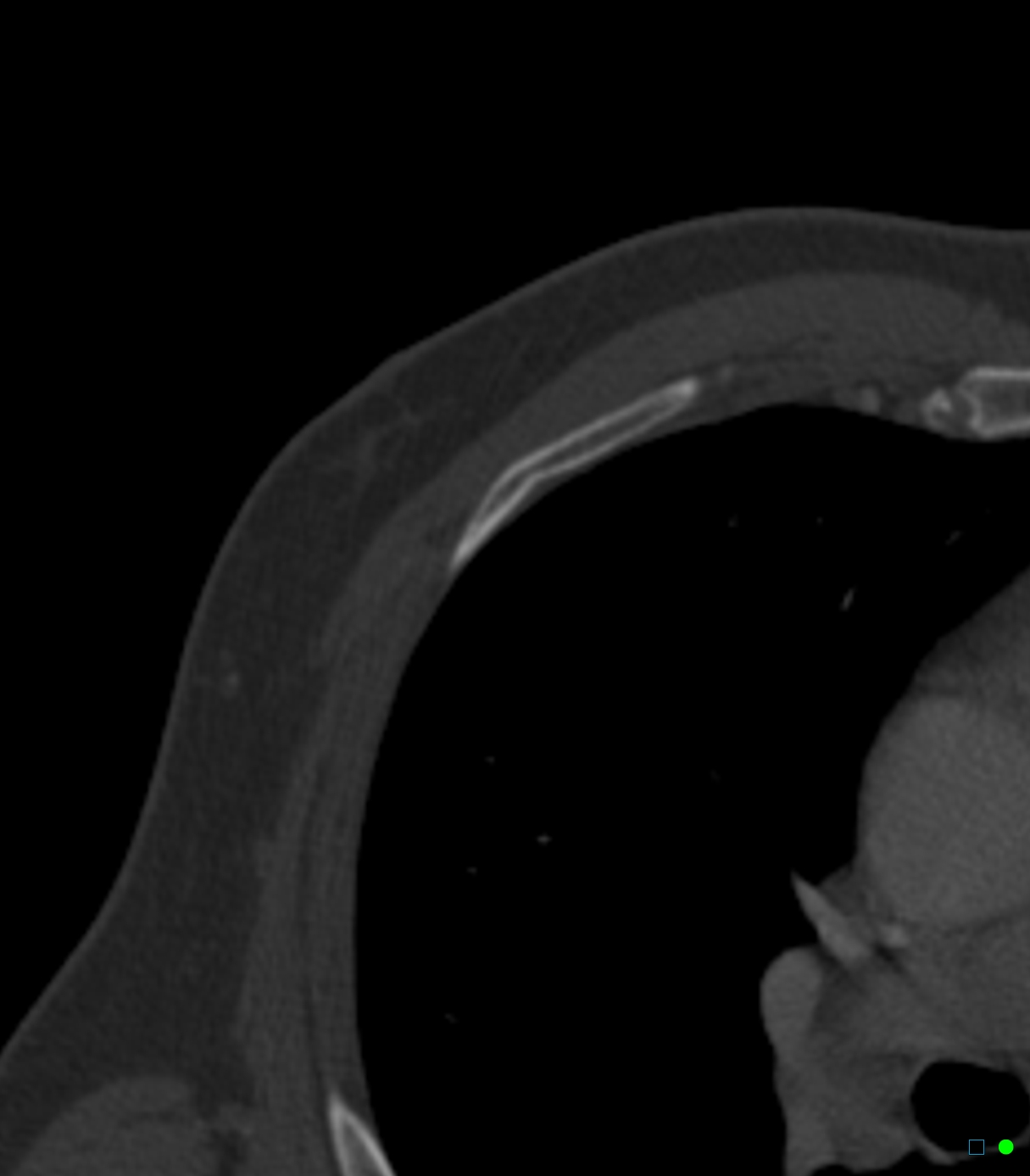 Buckle Rib Fractures Image Radiopaedia Org