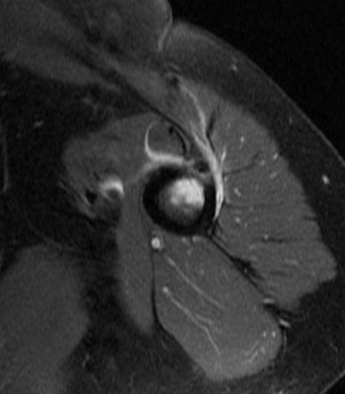 Calcific Tendinitis Of The Pectoralis Major Insertion Radiology Case