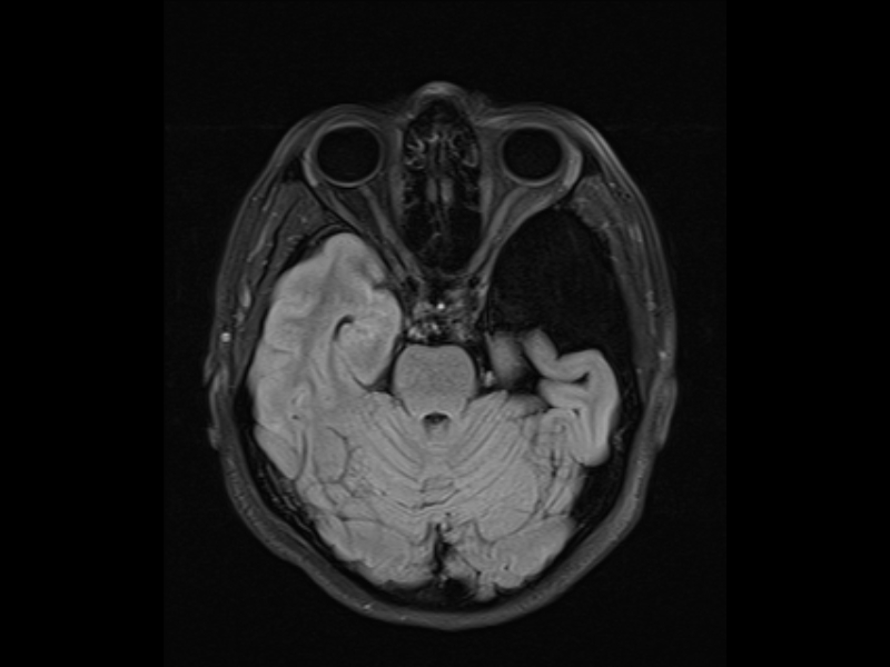 Arachnoid Cyst Galassi Type III Image Radiopaedia Org