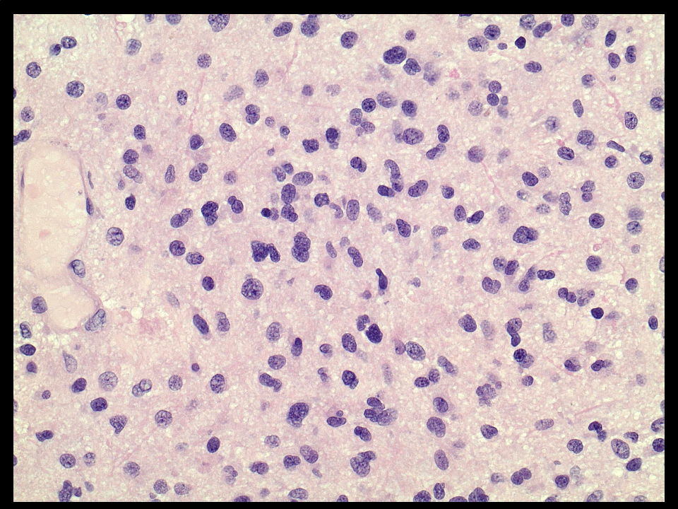 Left Frontal Low Grade Glioma Image Radiopaedia Org