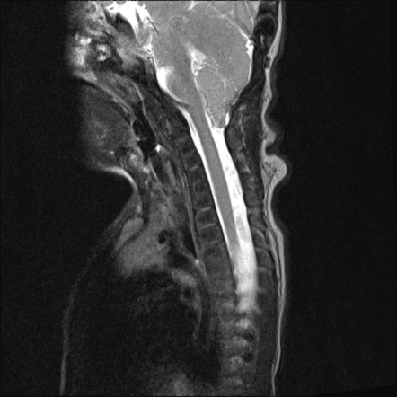 Pfeiffer Syndrome Craniosynostosis Image Radiopaedia Org