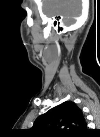 Neurofibroma Of The Vagus Nerve Image Radiopaedia Org