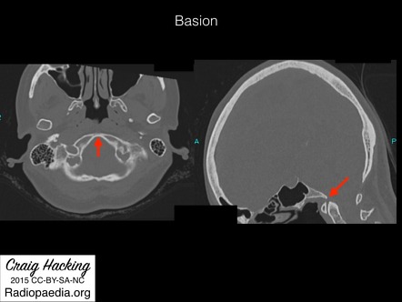 Skull Landmarks Annotated Images Radiology Case Radiopaedia Org