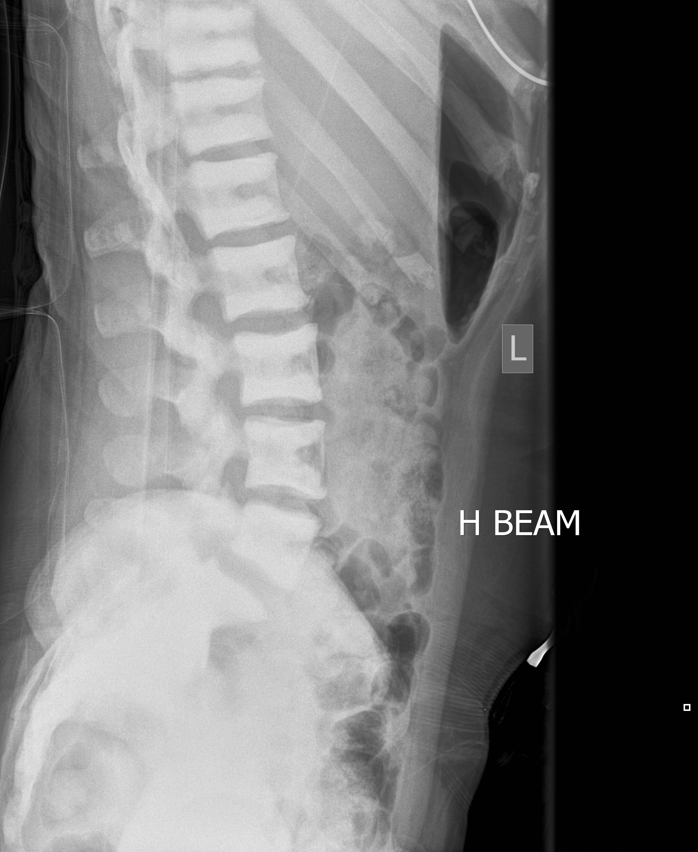 Osteopetrosis Image Radiopaedia Org