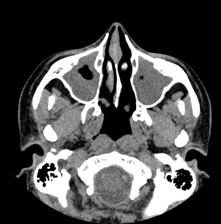 Acute Sinusitis Radiology Case Radiopaedia Org