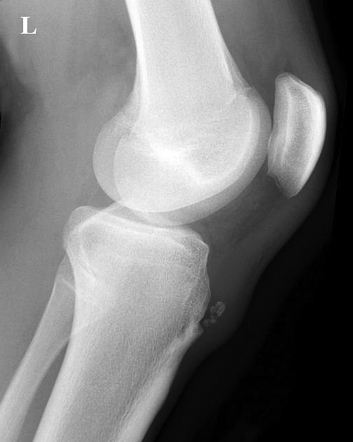 Osgood Schlatter Disease Radiology Case Radiopaedia Org