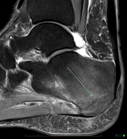 Insufficiency Fracture Radiology Reference Article Radiopaedia Org