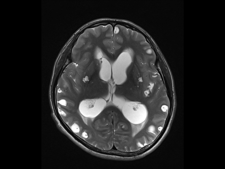 Viewing Playlist Cns Radiopaedia Org