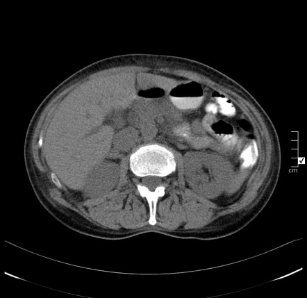 Pancreatic Neuroendocrine Tumor Well Differentiated Image