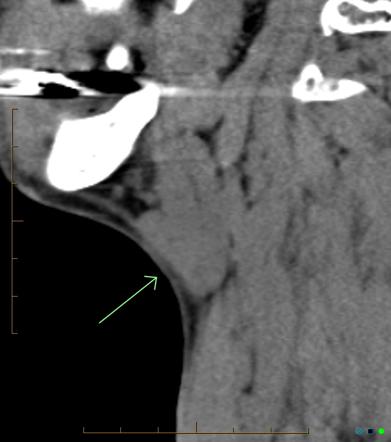 Chronic Submandibular Sialolithiasis Image Radiopaedia Org