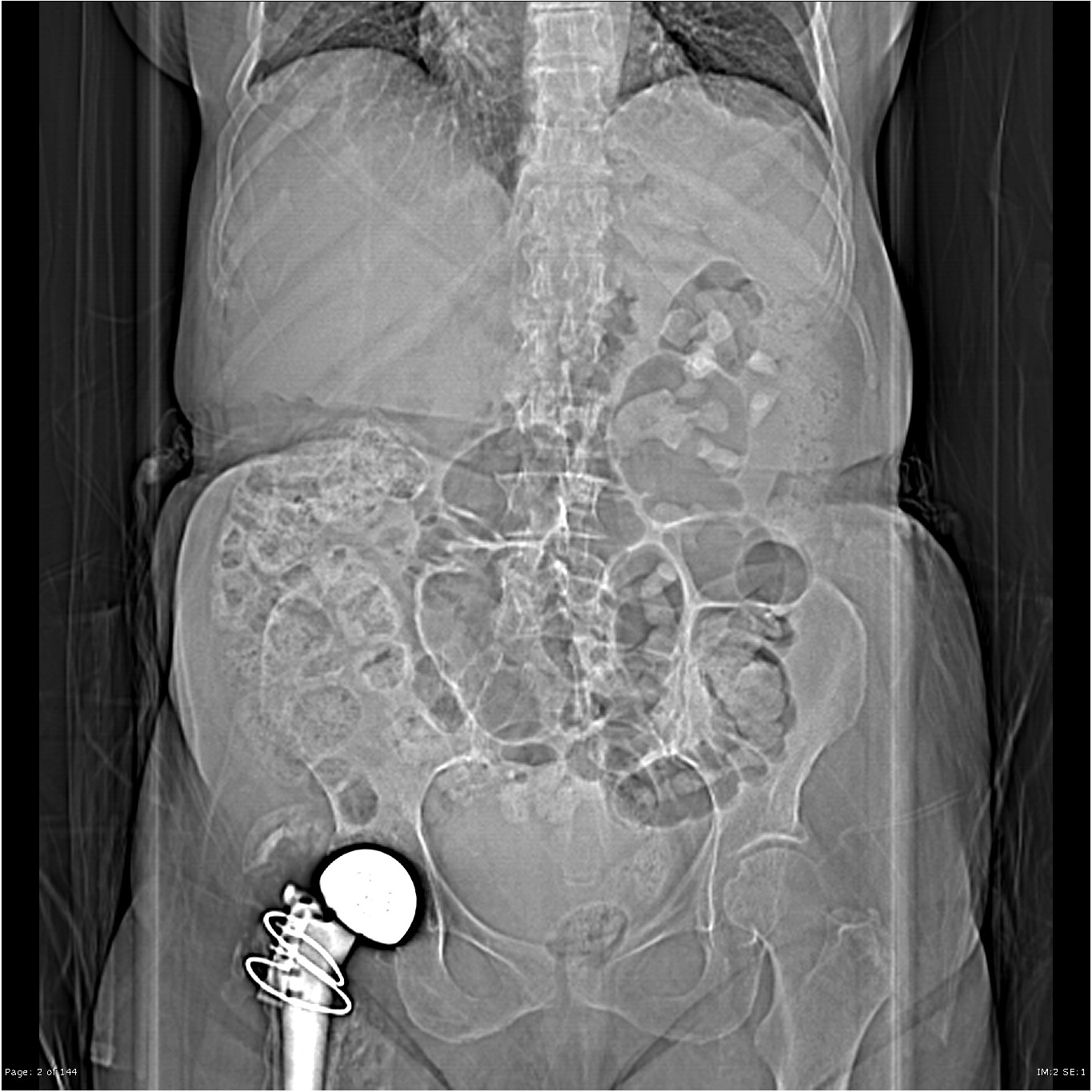 Xanthogranulomatous Pyelonephritis With Perinephric Abscess Image