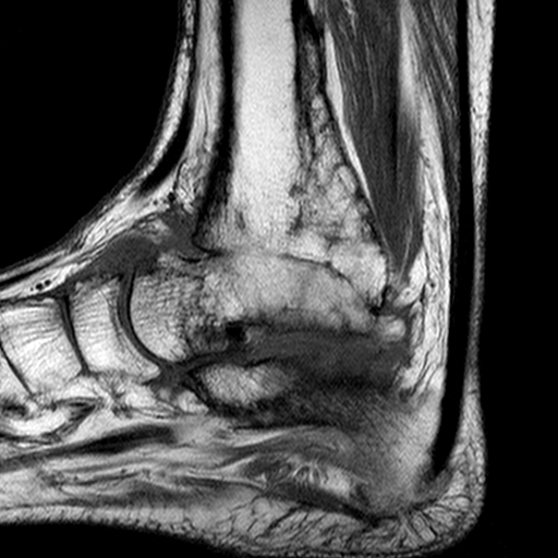 Posttraumatic Ankle Joint Ankylosis Image Radiopaedia Org