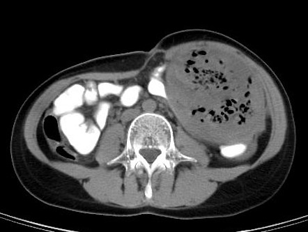 Gossypiboma Radiology Case Radiopaedia Org