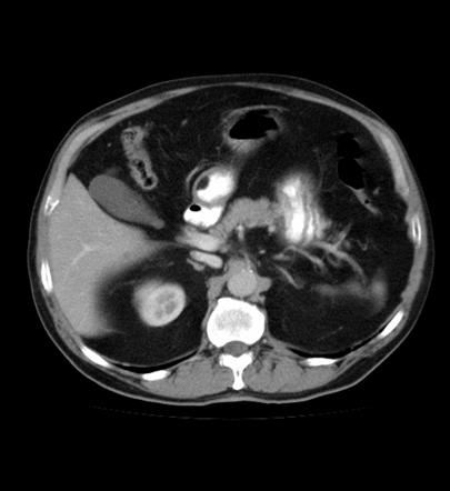 Gastrointestinal Tract Lipomas Radiology Reference Article