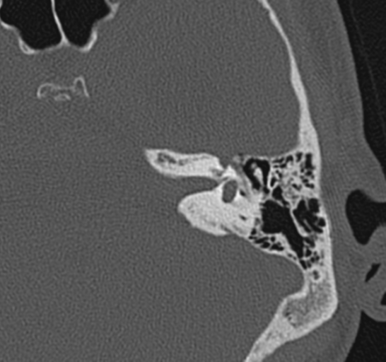 Cystic Acoustic Schwannoma Image Radiopaedia Org