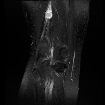 Peripheral Nerve Sheath Tumour Of The Sciatic Nerve Radiology Case