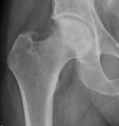 Avascular Necrosis Of The Hip Radiology Reference Article