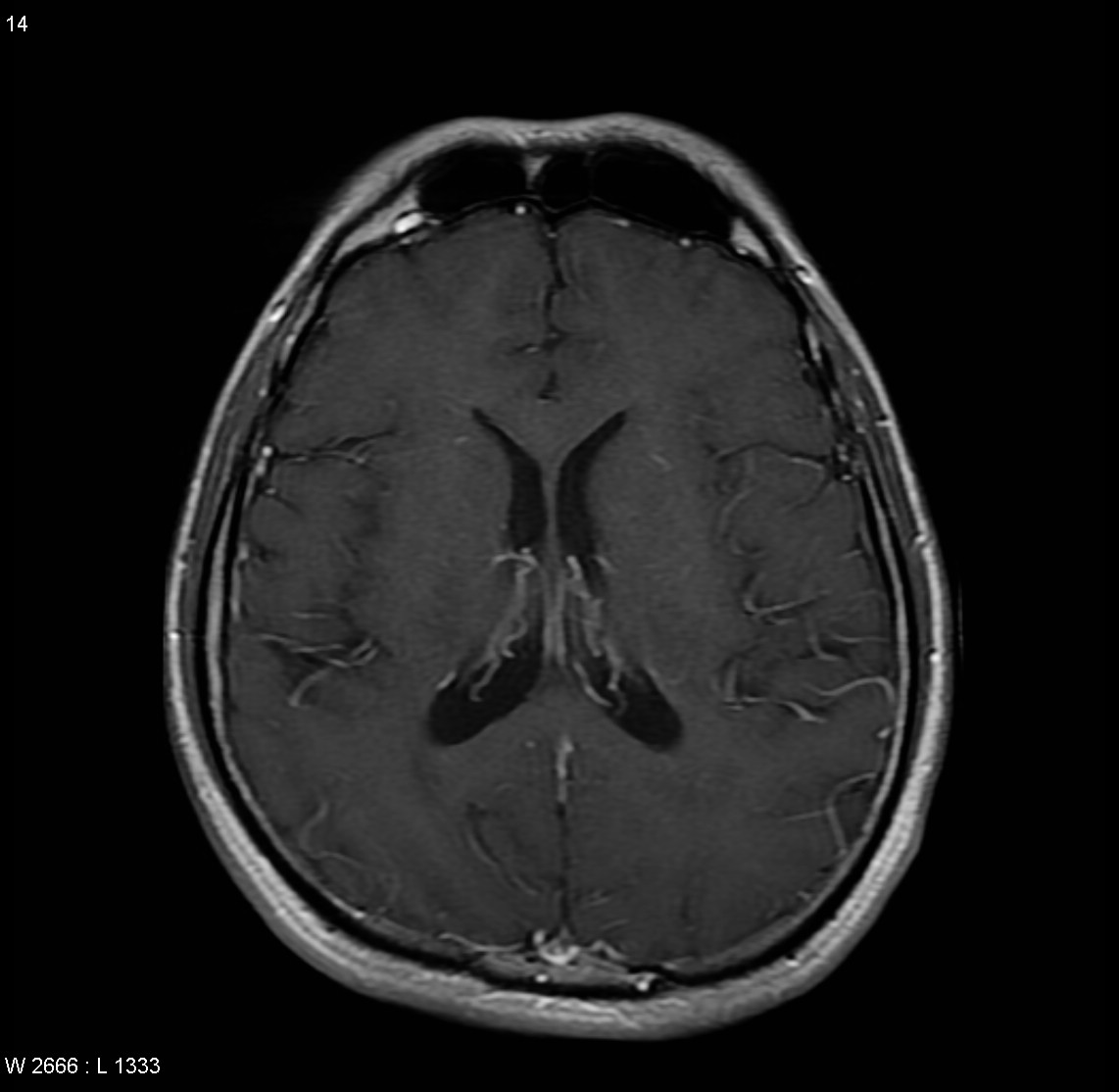 Cerebral Vasculitis Image Radiopaedia Org