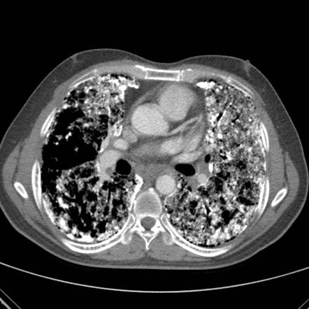 Pulmonary Alveolar Microlithiasis Radiology Reference Article Radiopaedia Org