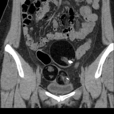 Bilateral Mature Cystic Teratomas Radiology Case Radiopaedia Org