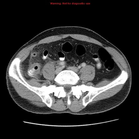 Radiology Quiz Radiopaedia Org Playlist Abdominal Pain Cases