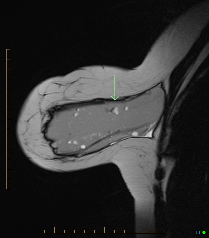 Blowjob mri