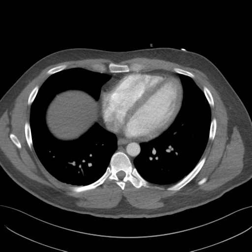 Normal Cta Thorax Non Ecg Gated Image Radiopaedia Org